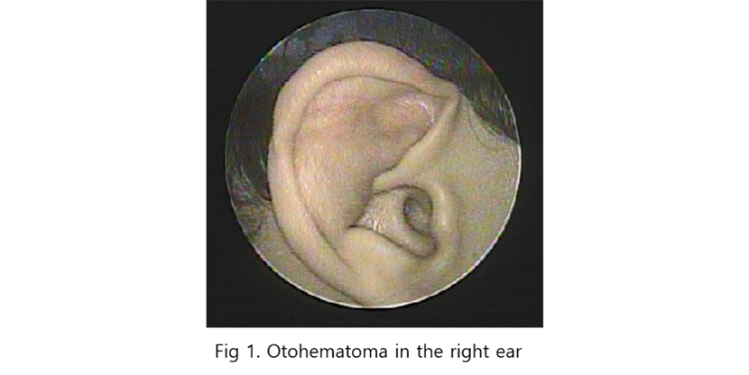 Fig 1. Otohematoma in the right ear