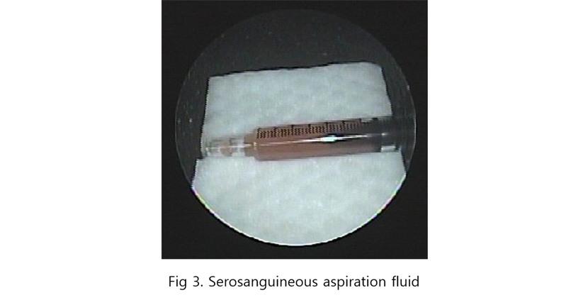 Fig 3. Serosanguineous aspiration fluid